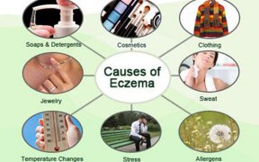 Eczema Causes