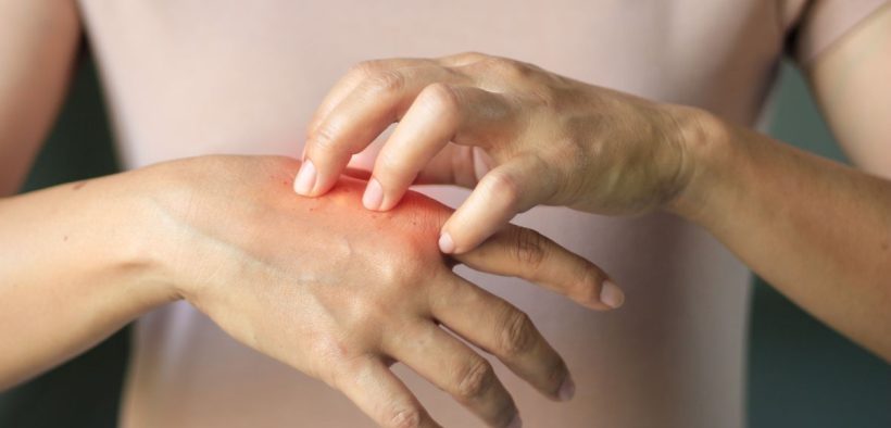 Lupus symptoms to look out for - three most common signs of Lupus and 11 symptoms to be aware of