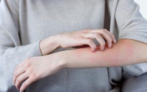 Eczema Skin Relief - Prevention And Treatment Report