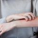 Eczema Skin Relief - Prevention And Treatment Report