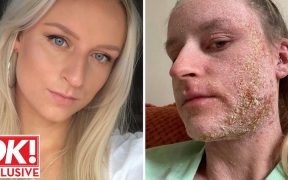 'Topical steroid withdrawal after treating eczema left me feeling worthless'
