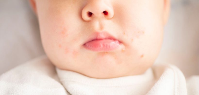 Pediatric Dermatology Update: 2022’s Top Studies