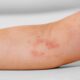 New atopic dermatitis treatments in development