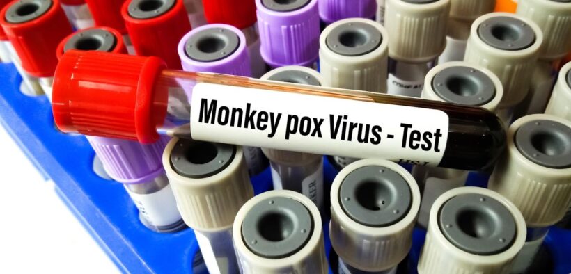 First U.S. Monkeypox Death Reported in Texas - Consumer Health News