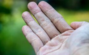 Eczema Therapeutics Market: Share, Size, CAGR, Growth,