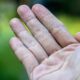 Eczema Therapeutics Market: Share, Size, CAGR, Growth,