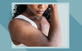 Eczema in Black Skin: Symptoms, Diagnosis, Treatment