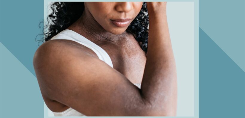 Eczema in Black Skin: Symptoms, Diagnosis, Treatment