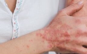 Baricitinib Effective in Atopic Dermatitis Patients who Failed Dupilumab