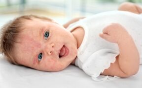 Non-invasive Test That May Help Predict Eczema in Babies