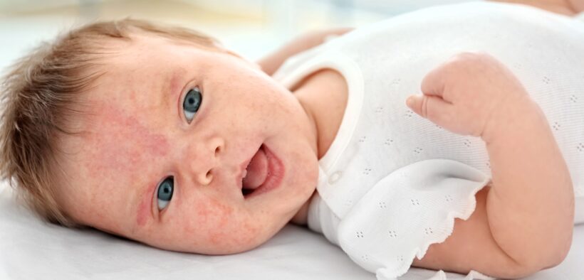 Non-invasive Test That May Help Predict Eczema in Babies
