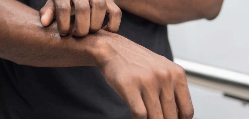 Copy of - Reistone reports positive phase III results for ivarmacitinib in atopic dermatitis