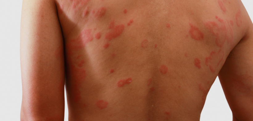 The Pharmacist’s Role in Atopic Dermatitis Treatment