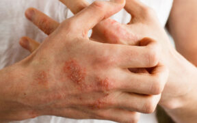 Eczema linked to increased symptom severity in children with autism spectrum disorder