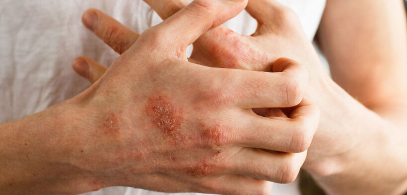 Eczema linked to increased symptom severity in children with autism spectrum disorder