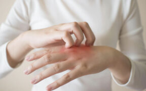 Tips to Stop Itching and Scratching Your Eczema