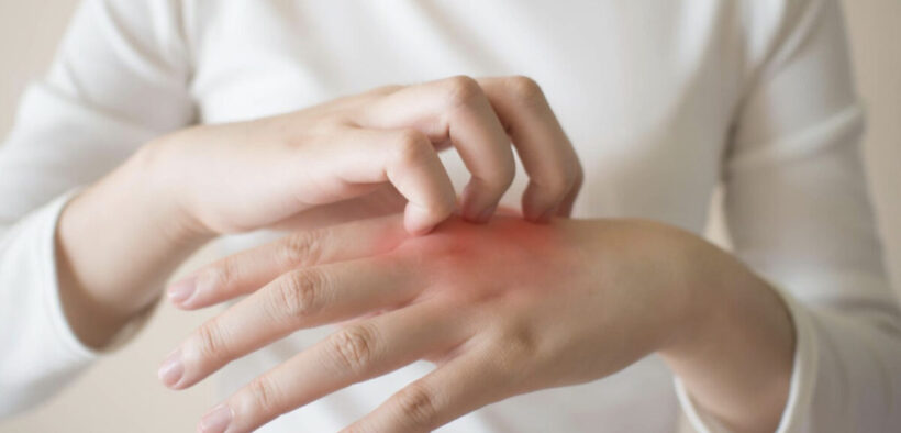 Tips to Stop Itching and Scratching Your Eczema