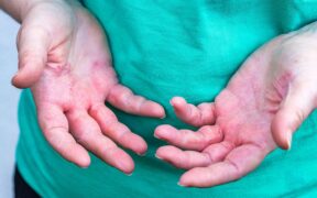 A photo of a woman's hands affected by atopic dermatitis.