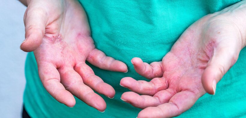 A photo of a woman's hands affected by atopic dermatitis.