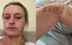 Woman, 25, Bedbound by Topical Steroid Withdrawal