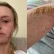 Woman, 25, Bedbound by Topical Steroid Withdrawal