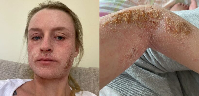 Woman, 25, Bedbound by Topical Steroid Withdrawal