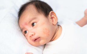 Eczema Associated With Heightened Risk of Peanut Allergy in Infants
