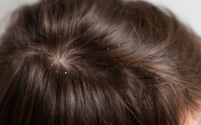 Washing your hair less or using too many products can worsen dandruff. Do this instead