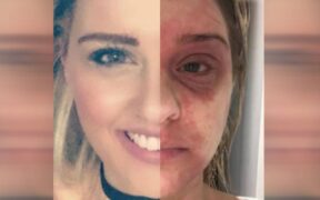 'Rollercoaster to hell': Woman's skin condition nightmare