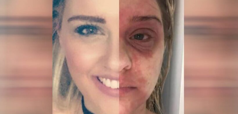 'Rollercoaster to hell': Woman's skin condition nightmare
