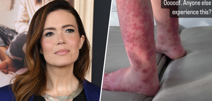 What Is Gianotti-Crosti Syndrome? Mandy Moore Shares Son's Diagnosis On Instagram