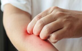 Anti-inflammatory diet can help find eczema triggers