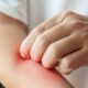 Anti-inflammatory diet can help find eczema triggers