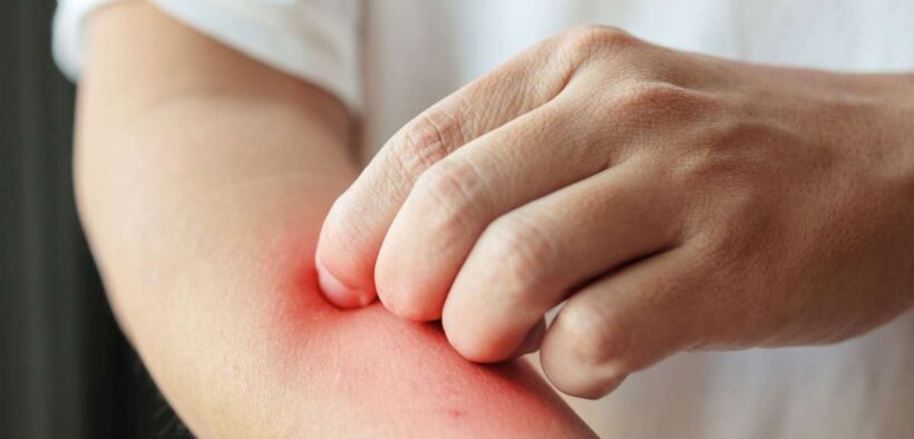 Anti-inflammatory diet can help find eczema triggers