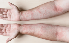 Kuwait's Health Challenge: 10,000+ Children Suffer From Atopic Eczema - ARAB TIMES