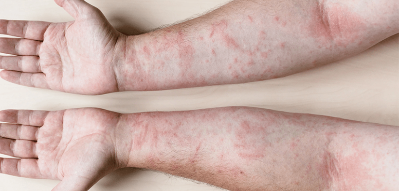Kuwait's Health Challenge: 10,000+ Children Suffer From Atopic Eczema - ARAB TIMES