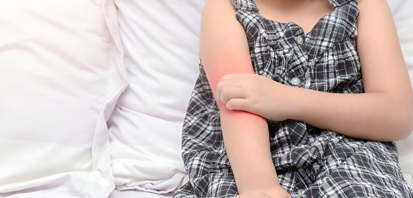 Is it eczema or psoriasis? An expert offers advice