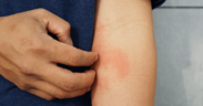 Understanding Eczema: A Common Skin Condition Among Kids In Kuwait - ARAB TIMES