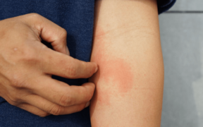 Understanding Eczema: A Common Skin Condition Among Kids In Kuwait - ARAB TIMES