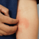 Understanding Eczema: A Common Skin Condition Among Kids In Kuwait - ARAB TIMES