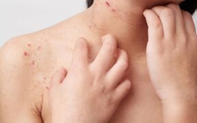 Will eliminating dairy help to improve eczema symptoms?