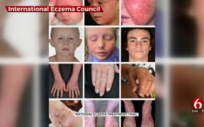 National Eczema Treatment Trial Looking For Participants In Tulsa