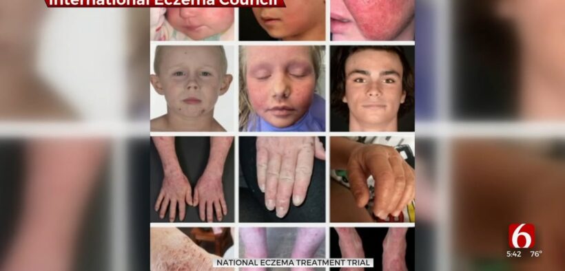 National Eczema Treatment Trial Looking For Participants In Tulsa