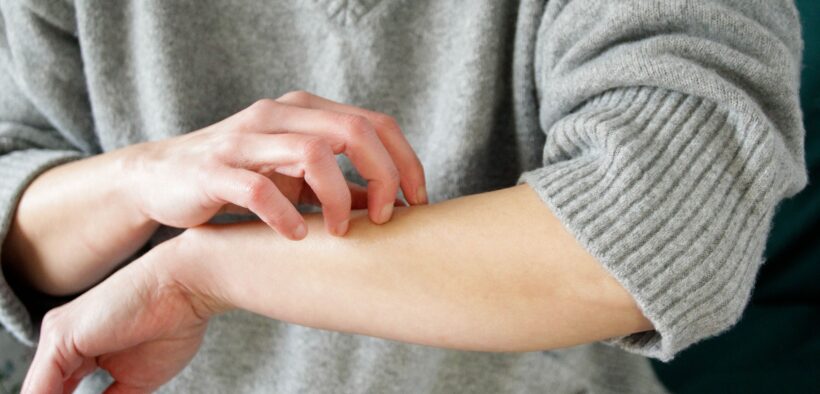 Hopes of cure for eczema itchiness as scientists identify what causes urge to scratch