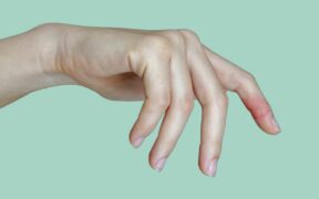 The Different Stages of Atopic Dermatitis—and How to Treat Each