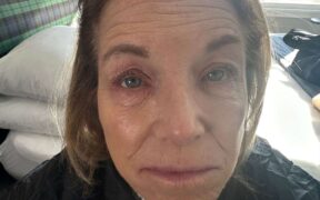 Katie Couric Shows Eczema Flare-Up in Vulnerable Photo