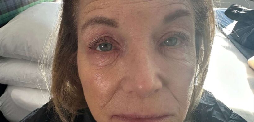 Katie Couric Shows Eczema Flare-Up in Vulnerable Photo