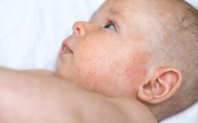 Prenatal Exposure to Opioids Linked to Increased Odds of Eczema and Dermatitis