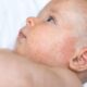 Prenatal Exposure to Opioids Linked to Increased Odds of Eczema and Dermatitis