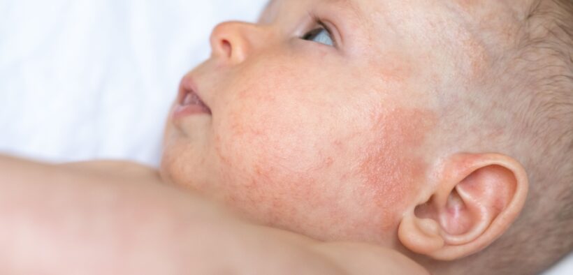 Prenatal Exposure to Opioids Linked to Increased Odds of Eczema and Dermatitis